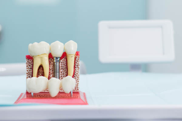 Understanding The Dental Implant Process