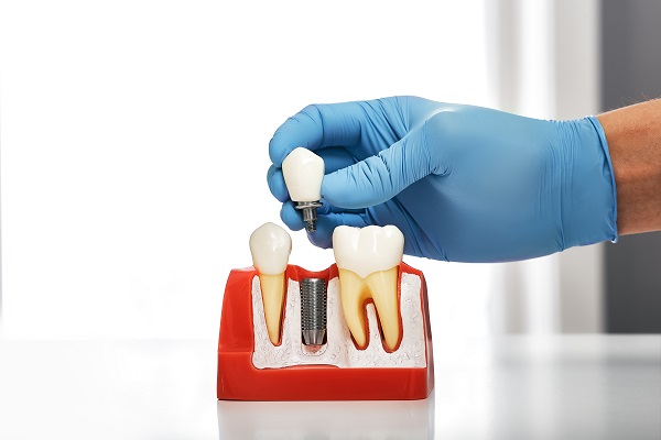 Things You Should Know About Dental Implants Posts