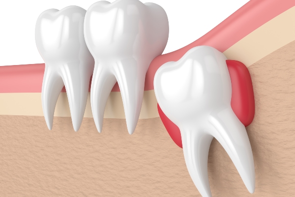 Go to an Emergency Dentistry to Deal With an Impacted Wisdom Tooth from CDC Dental Center in North Hollywood, CA