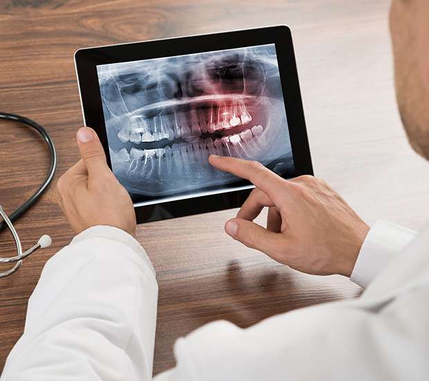 North Hollywood Types of Dental Root Fractures